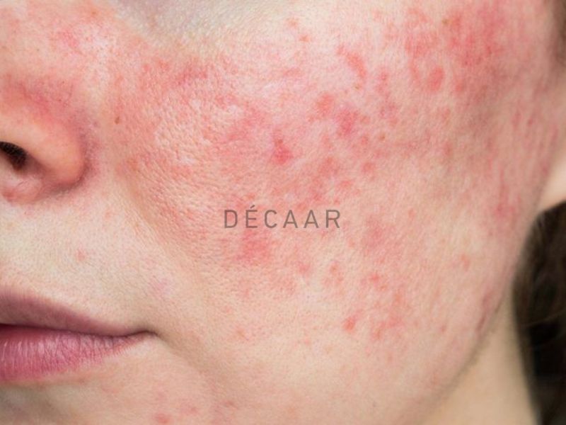 da bị nhiễm corticoid